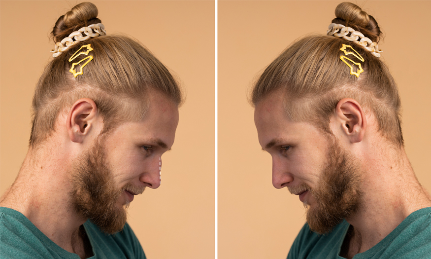 Erkek Burun Estetiği Profil Örneği