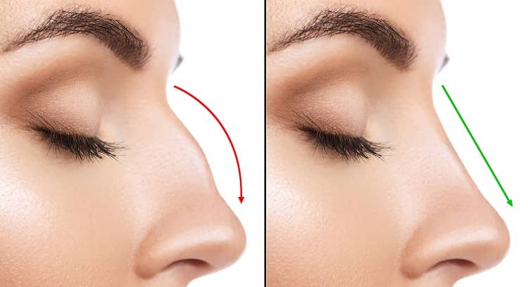 burun-estetigi-rhinoplasty-izmir