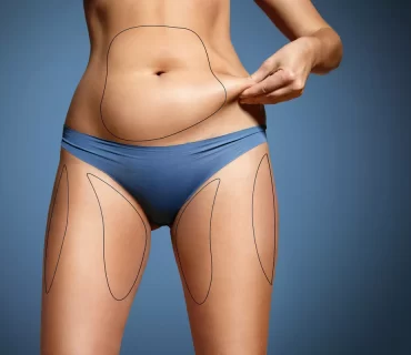 Liposuction: İnatçı Yağlardan Kurtul